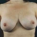 Breast Round, Saline