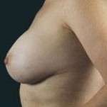 Breast Round, Saline
