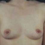 Breast Round, Saline