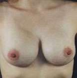 Breast Round, Saline