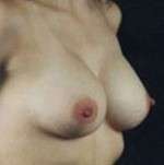 Breast Round, Saline