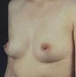 Breast Round, Saline
