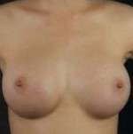 Breast Round, Saline