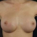 Breast Round, Saline