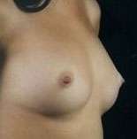 Breast Round, Saline