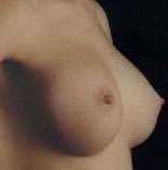 Breast Round, Saline