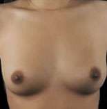 Breast Round, Saline