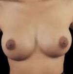 Breast Round, Saline