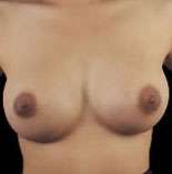 Breast Round, Saline