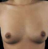 Breast Round, Saline