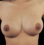 Breast Round, Saline