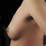 Breast Round, Saline