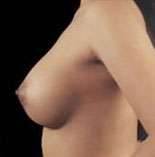 Breast Round, Saline