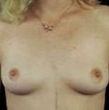 Breast Round, Saline