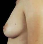 Breast Round, Saline