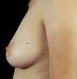 Breast Round, Saline