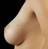Breast Round, Saline