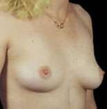 Breast Round, Saline