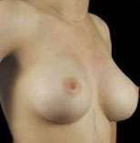 Breast Round, Saline