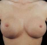 Breast Round, Saline