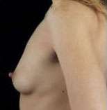 Breast Round, Saline