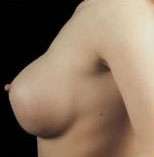 Breast Round, Saline