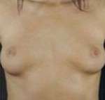 Breast Round, Saline