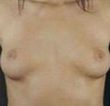 Breast Round, Saline