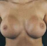 Breast Round, Saline