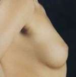 Breast Round, Saline