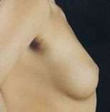 Breast Round, Saline