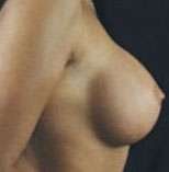 Breast Round, Saline