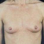 Breast Round, Saline