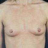 Breast Round, Saline