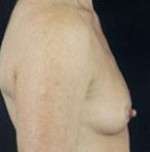 Breast Round, Saline