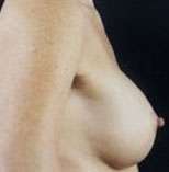 Breast Round, Saline
