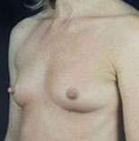 Breast Round, Saline
