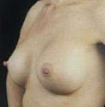 Breast Round, Saline
