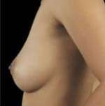 Breast Round, Saline