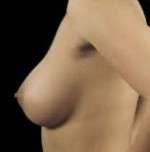 Breast Round, Saline
