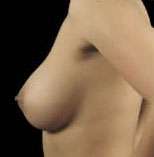 Breast Round, Saline