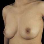 Breast Round, Saline