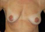 Breast Augmentation, Gel