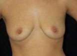 Breast Augmentation, Gel