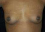 Breast Augmentation, Gel