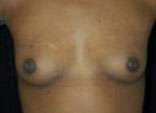 Breast Augmentation, Gel