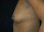 Breast Augmentation, Gel