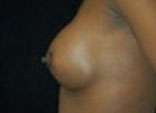 Breast Augmentation, Gel