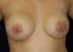 Breast Augmentation, Gel