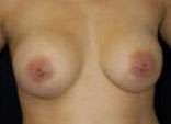 Breast Augmentation, Gel